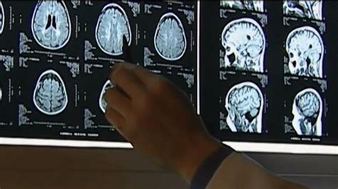 Study Finds Transplanted Brain Cells Can Repair Ms Damage Wham