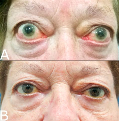 Resolved Heart Tamponade And Controlled Exophthalmos Facial Pain And