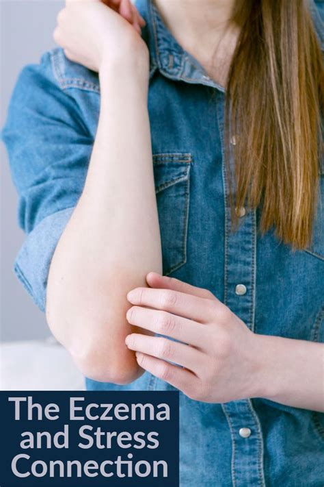 The Eczema And Stress Connection What You Need To Know Everyday