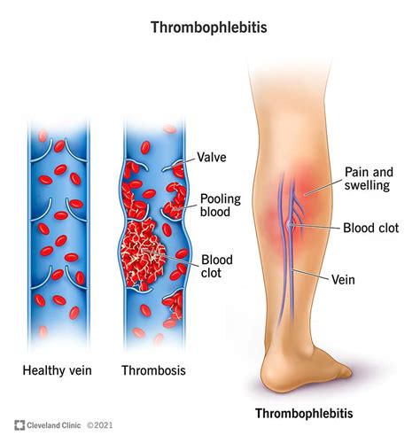 Understanding Thrombophlebitis Causes Symptoms Treatment And Prevention