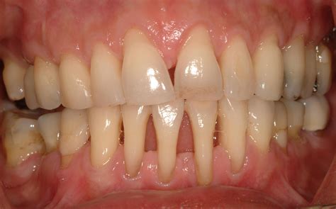 Acute Gingival And Periodontal Conditions Lesions Of