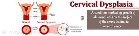 Cervical Dysplasia Causes Symptoms Diagnosis Treatment And Prevention