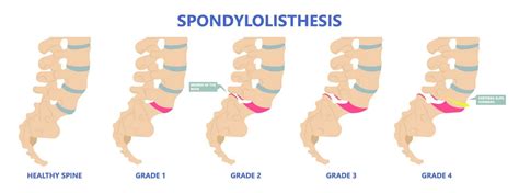 Retrolisthesis Definition Spine Info