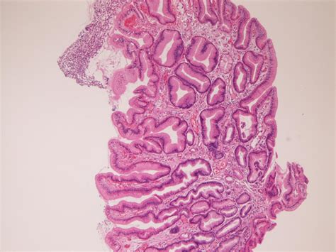 Pathologic Observations Of The Duodenum In 615 Consecutive Duodenal