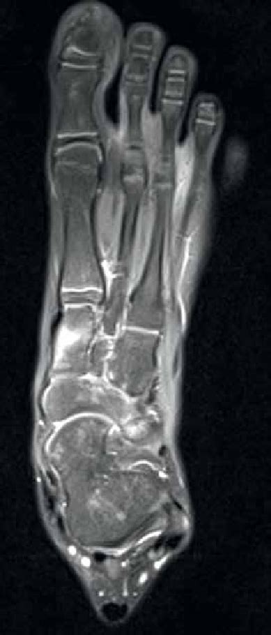 Bone Marrow Edema Foot Treatment Quotes Update Viral Vrogue Co