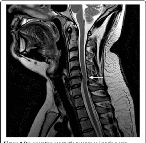 Cervical Disc Herniation Presenting With Neck Pain And Contralateral
