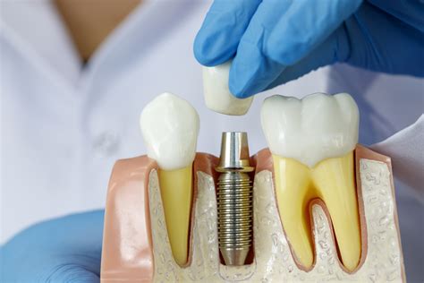 What You Need To Know About Dental Implants Fairfield Dental Arts