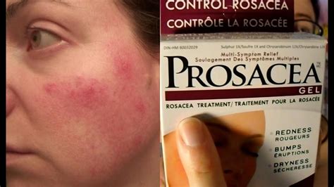 Prosacea Rosacea Treatment Product Review Not Sponsored Rosy