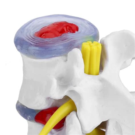 Anatomical Lumbar Disc Herniation Demonstration Model Human Spine