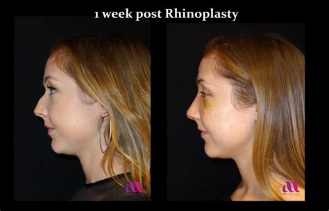 Rhinoplasty Nose Job A M Aesthetic Surgery