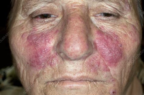 Acne Rosacea On The Face Stock Image C0119514 Science Photo Library