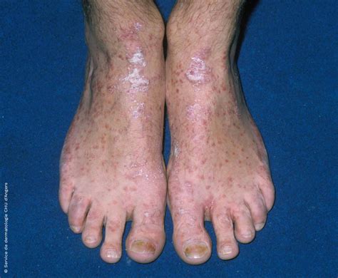 Eczema O Psoriasis Fundación Eczema