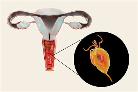 Female Trichomoniasis Illustration Showing Vaginitis And Closeup View