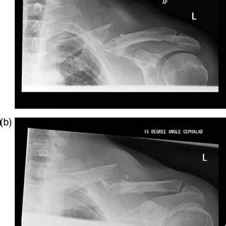 Middle third comminuted diaphyseal clavicle fracture in a ...