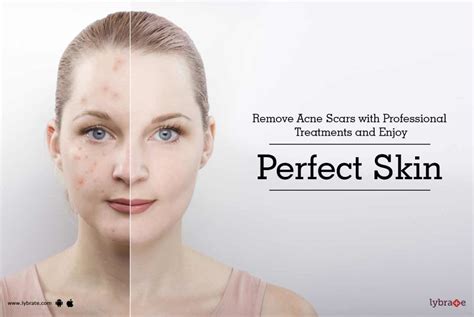 Remove Acne Scars With Professional Treatments And Enjoy Perfect Skin