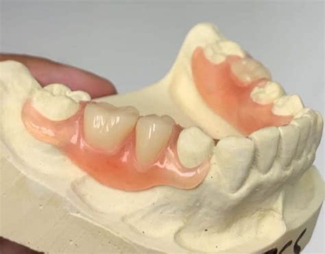 flexible partial dentures in los algodones dental solutions algodones