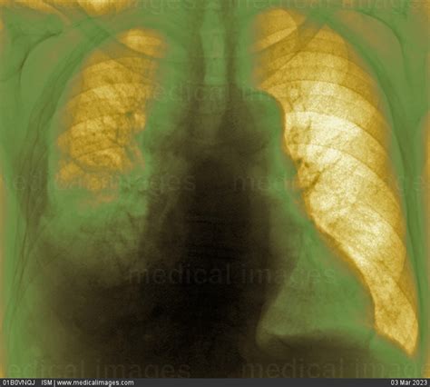 Stock Image Small Cell Lung Cancer Mediastinal Mass Visible By The