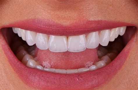 Lentes De Contato Dentais Zona Norte Amsterdam Odontologia