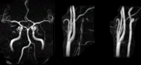 Vertebral Artery Dissection Mri