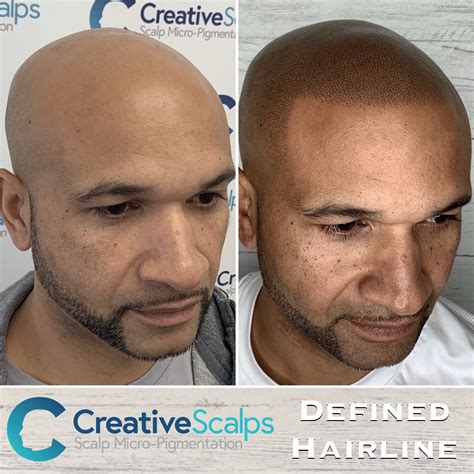 For amca approved hair loss training and smp training, take on line and onsite courses. Scalp Micropigmentation before & after results | Best SMP ...