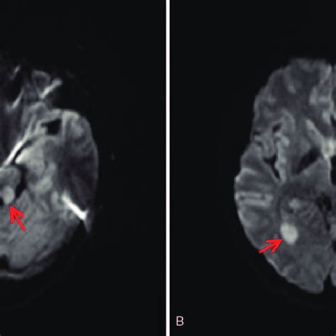 Brain Diffusion Weighted Magnetic Resonance Imaging Mri Dwi Of The