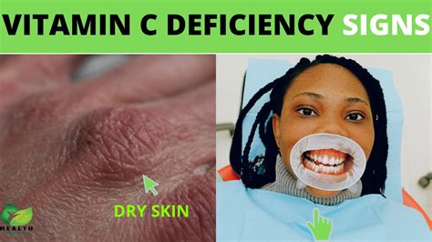 Vitamin C Deficiency 7 Signs And Symptoms YouTube