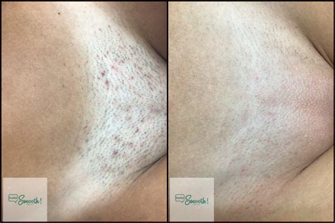 ofset Circulo kráľovná full brazilian laser hair removal skôr Becks