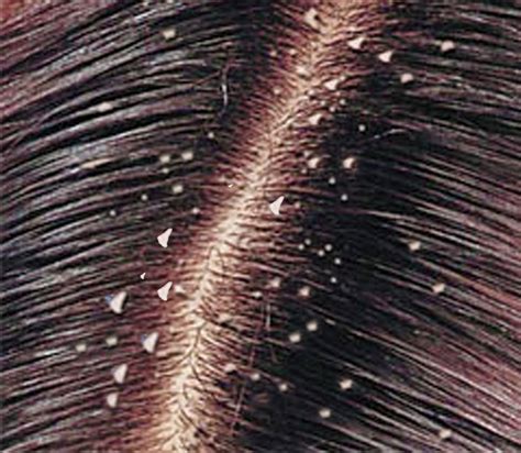 Tips cara menghilangkan ketombe dan mencegah rambut rontok | Seputar