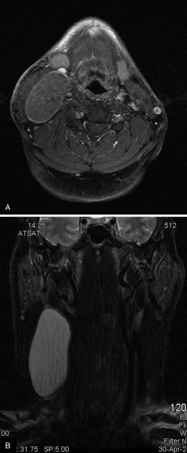 Cystic Masses Of The Supraclavicular Fossa Clinical Features And