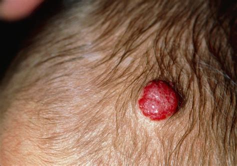 interventions for infantile hemangiomas which are effective dermatology advisor