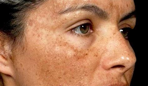 Tricks To Get Rid Of Dark Spots And Hyperpigmentation Musely