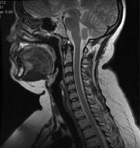 Image Gallery Healthy Cervical Spine Mri