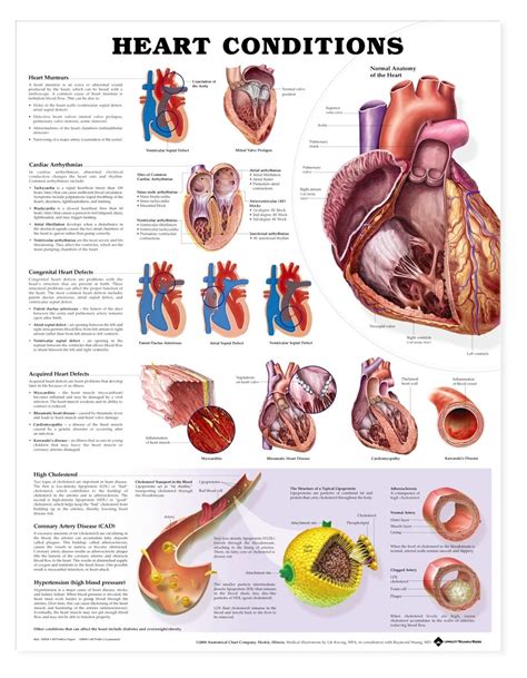 Heart Conditions Poster Heart Disease Anatomical Chart Company