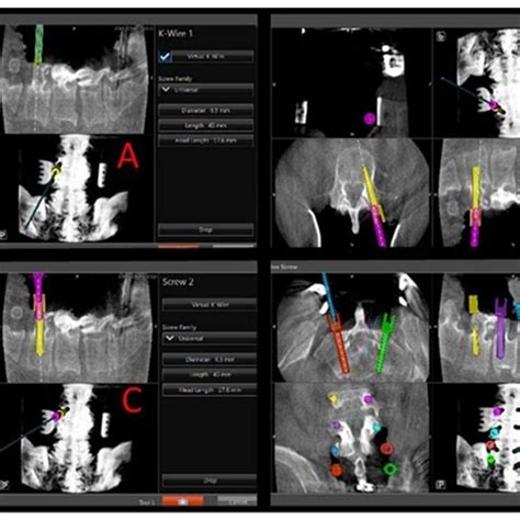 Intraoperative Views Of Navigation Screen Showing Steps Of Virtual