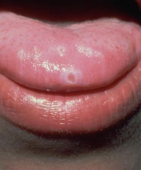 Pimple On Tongue