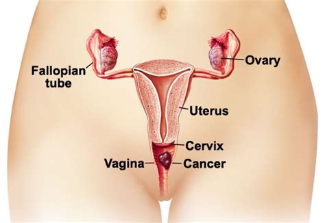 Vaginal Cancer Causes Symptoms Diagnosis And Treatment Natural