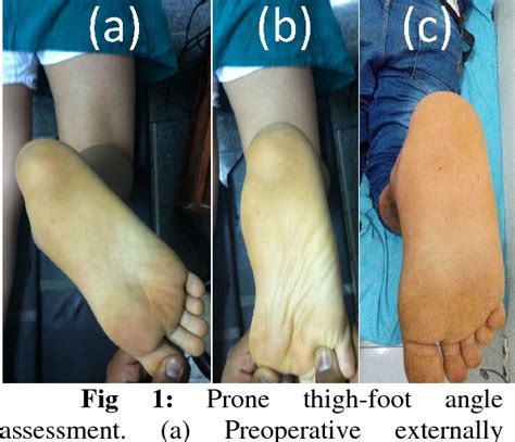Figure 1 From Management Of Symptomatic Flexible Flatfoot In