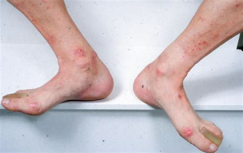 Aspecto de la dermatitis herpetiforme Medicina Básica