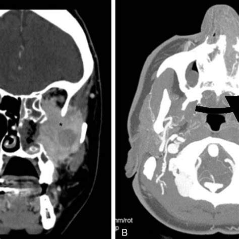Computed Tomography Ct Scan Showing A Left Nasal Cavity Mass