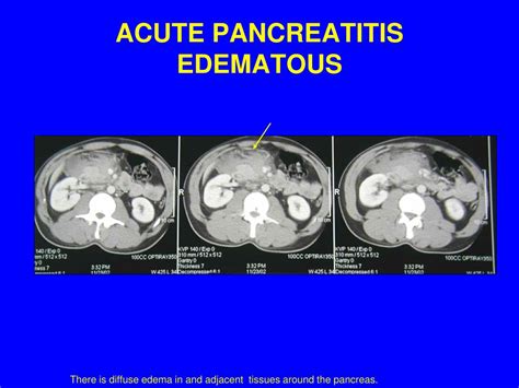 Ppt M 2 Hepatobiliary Imaging Powerpoint Presentation Free Download