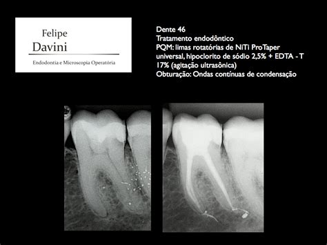 Davini Endodontia E Microscopia Operat Ria Tratamento Endod Ntico Dente Sess O Nica