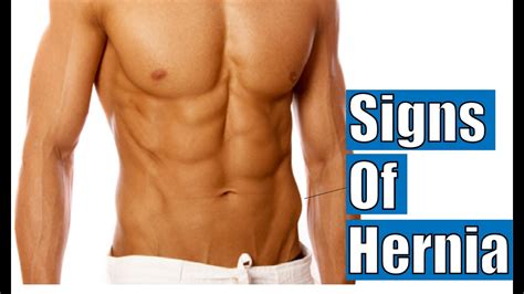 Signs Of Hernia Inguinal Hernia Symptoms Youtube