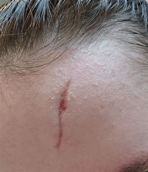 Forehead Laceration Caused By Running High Speed Into A Sheffield Lamp