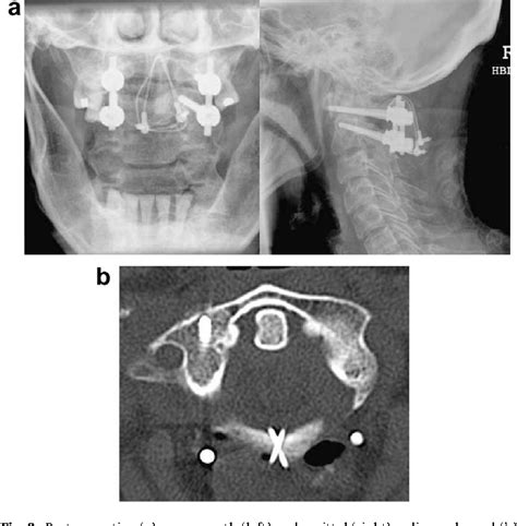 Figure 3 From Lateral C1c2 Dislocation Complicating A Type Ii Odontoid