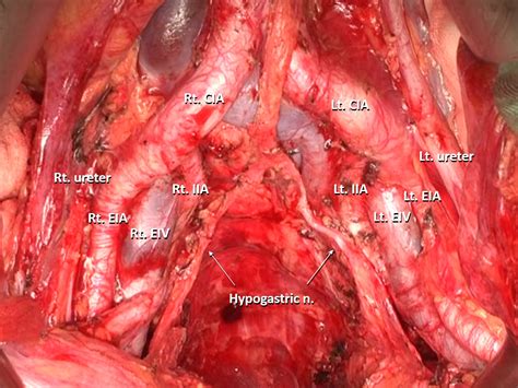 Ssat Complete Lateral Lymph Node Dissection Using A Transabdominal