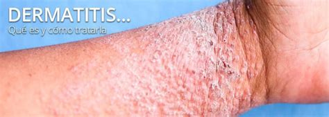 Dermatitis ¿qué Es Y Qué Tratamientos Tiene Tecnosa