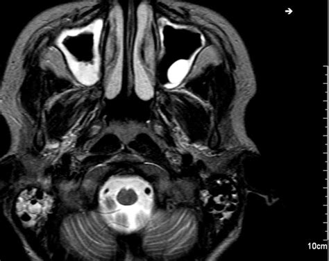 Northland Ear Nose And Throat Incidental Mri And Ct Findings In