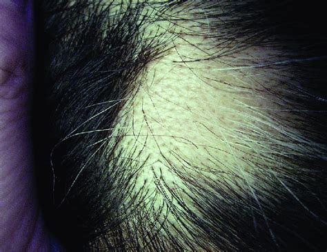Case 3 A Round Well Defined Patch Of Hair Loss On The Scalp With A