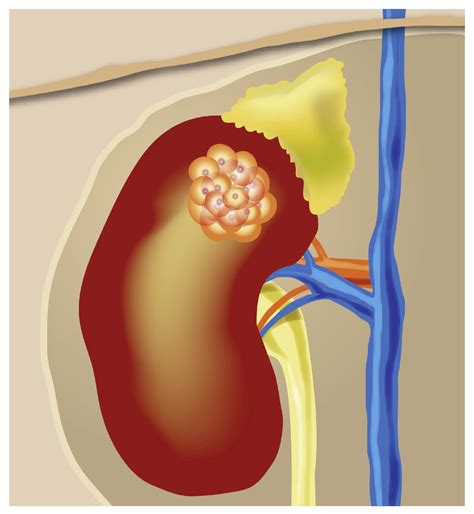 Biopsy Of Small Renal Massess Action Kidney Cancer