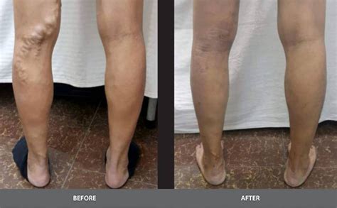 Varicose Veins Laser Haemorrhoids Vascular Surgery Treatment Kuala